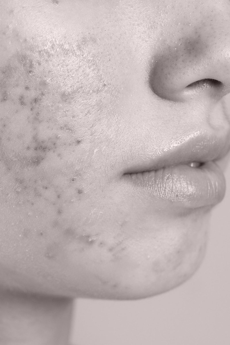 Acné et imperfections - Dr MARIA NORPO - Dermatologie - Esthétique - Chirurgie - BIARRITZ