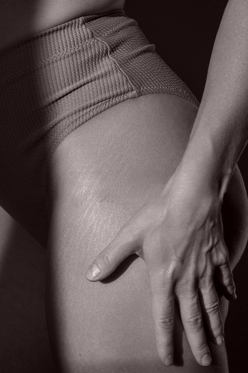 Vergetures et cicatrices - Dr MARIA NORPO - Dermatologie - Esthétique - Chirurgie - BIARRITZ