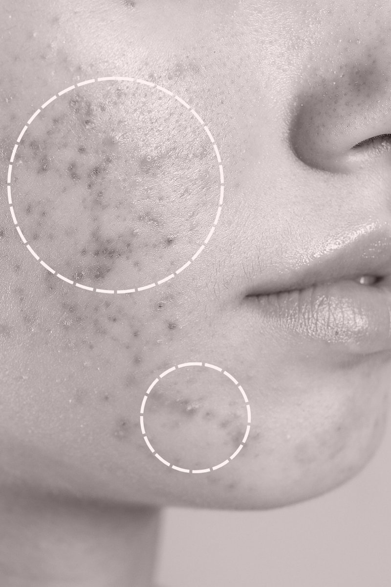 Acne scars - Dr MARIA NORPO - Dermatologie - Esthétique - Chirurgie - BIARRITZ